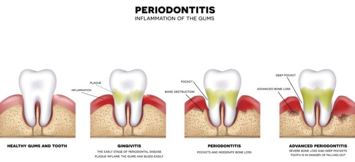 gum disease treatment in north liberty iowa