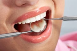 dental fillings with North Liberty Iowa dentist