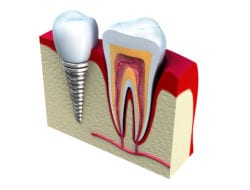 dental implants in north liberty IA