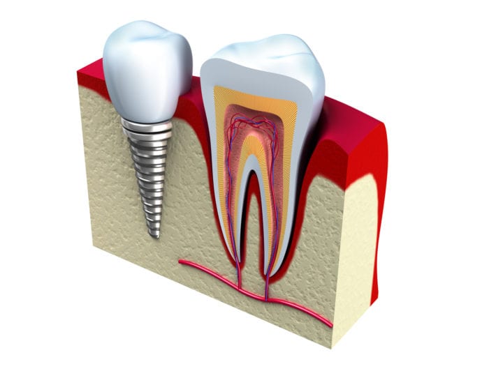 dental implants in Cedar Rapids, Iowa