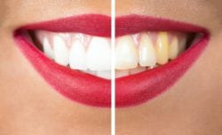 cosmetic dentistry in cedar rapids, ia