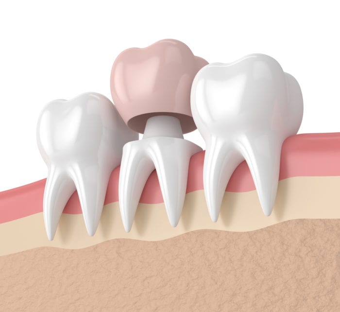 Affordable Dental Crowns in Cedar Rapids Iowa