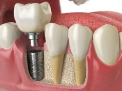 affordable dental implants in cedar rapids, iowa