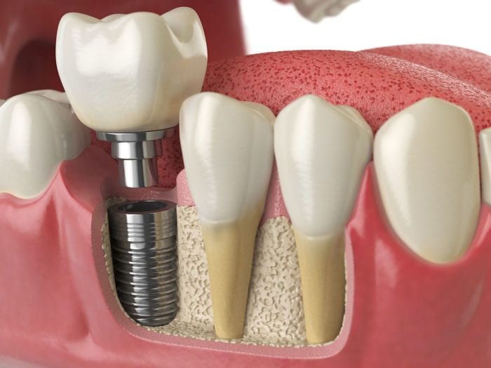 Dental Implant Process North Liberty, iowa