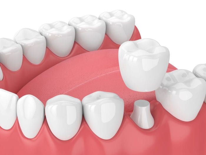 Uses of Dental Crowns in Cedar Rapids Iowa