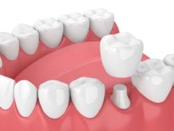 dental crowns in cedar rapids, iowa