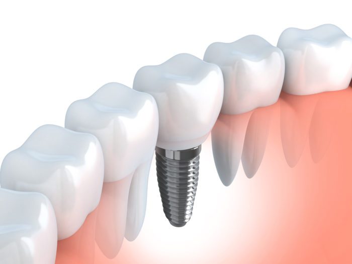 Single Dental Implants North Liberty, IA