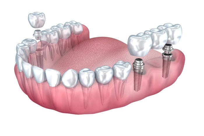 Dental Implant Benefits North Liberty IA