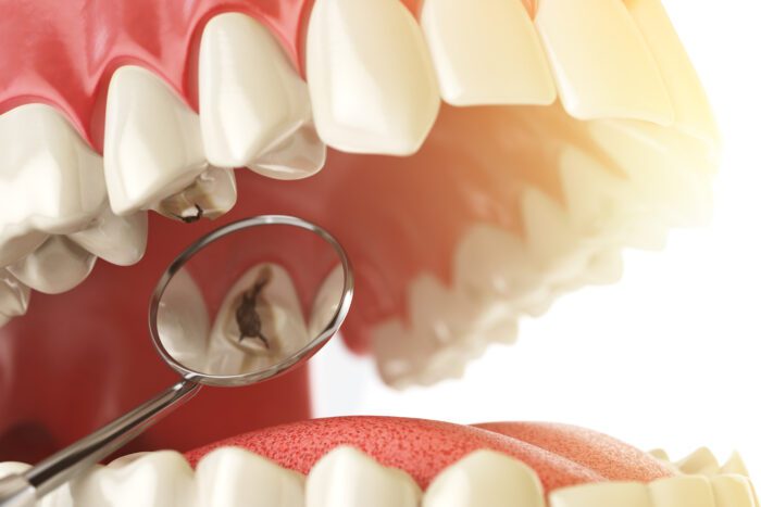 Design Dental offers treatment options for tooth decay in North Liberty, IA