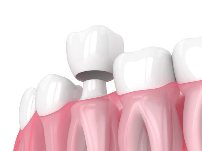 Dental Crowns in North Liberty IA