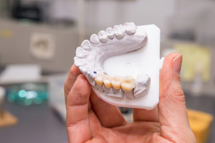 Dental Bridge Cedar Rapids IA
